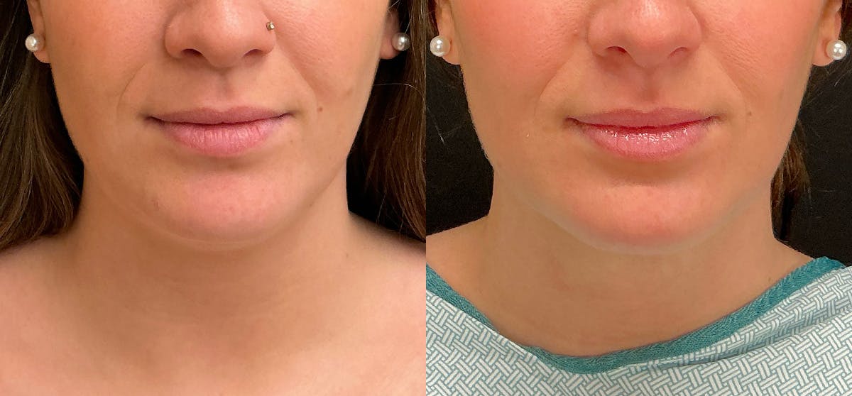 Liposuction Before & After Gallery - Patient 787627 - Image 3
