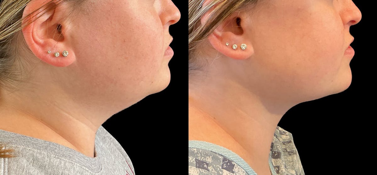 Liposuction Before & After Gallery - Patient 246447 - Image 1