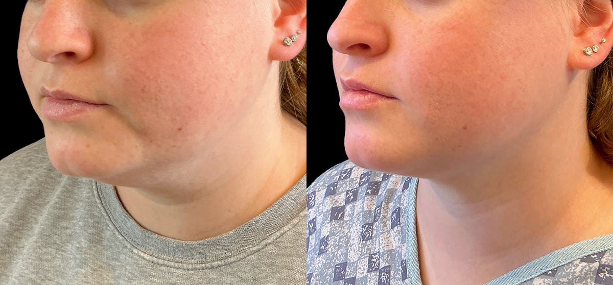 Liposuction Before & After Gallery - Patient 246447 - Image 3