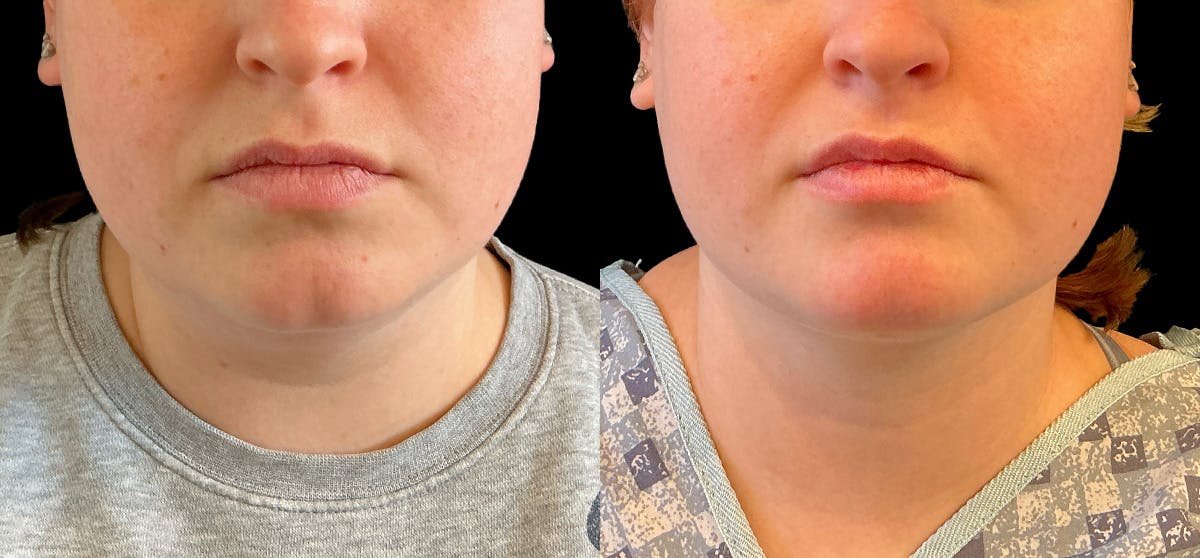 Liposuction Before & After Gallery - Patient 246447 - Image 2