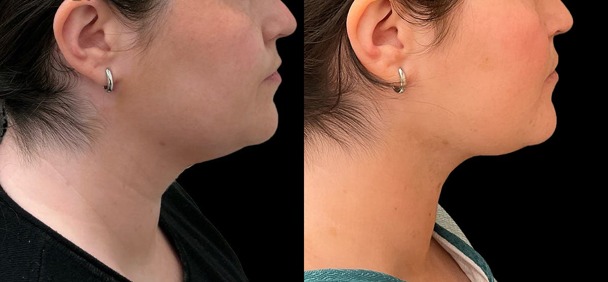 Liposuction Before & After Gallery - Patient 396577 - Image 1