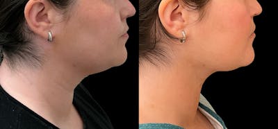Liposuction Before & After Gallery - Patient 396577 - Image 1