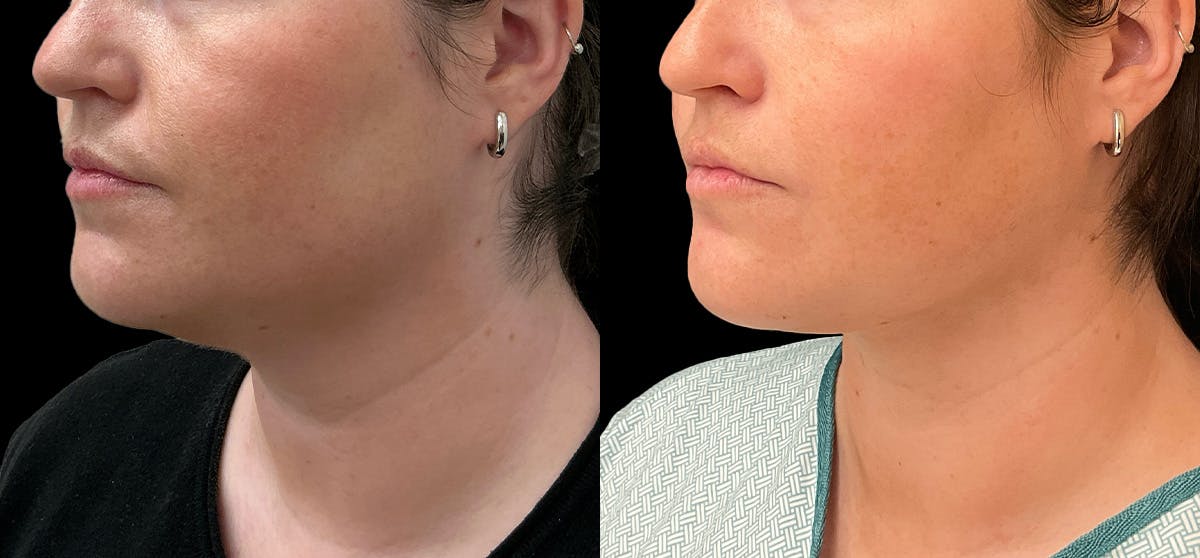 Liposuction Before & After Gallery - Patient 396577 - Image 2