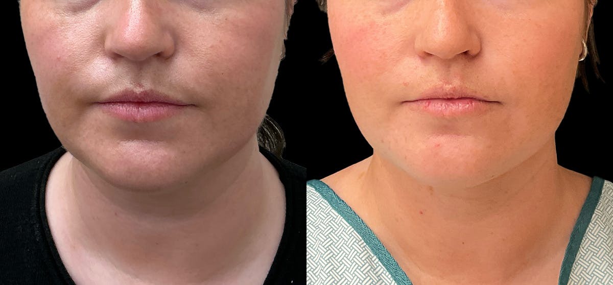 Liposuction Before & After Gallery - Patient 396577 - Image 3