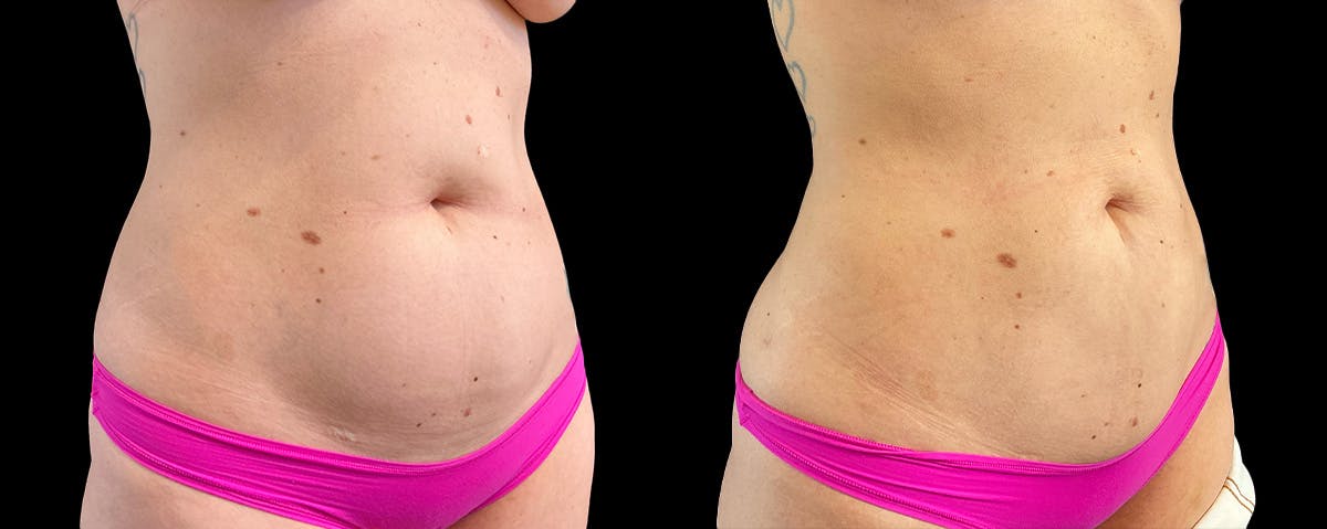 Mommy Makeover Before & After Gallery - Patient 214486 - Image 2
