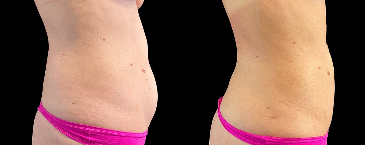 Mommy Makeover Before & After Gallery - Patient 214486 - Image 3