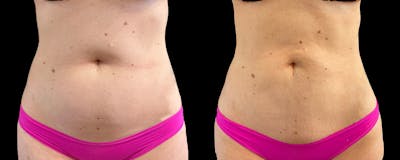 Mommy Makeover Before & After Gallery - Patient 214486 - Image 1
