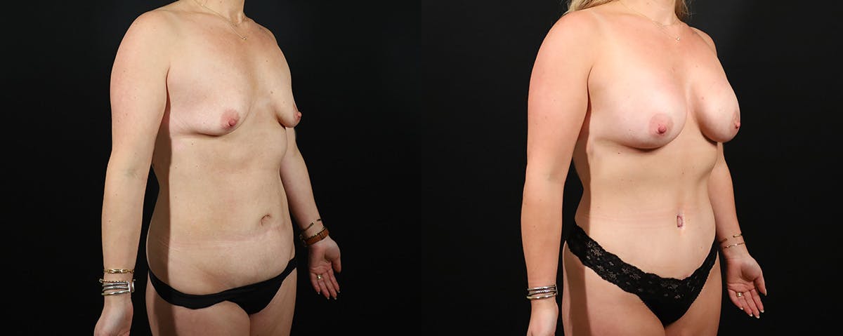 Mommy Makeover Before & After Gallery - Patient 166928 - Image 2