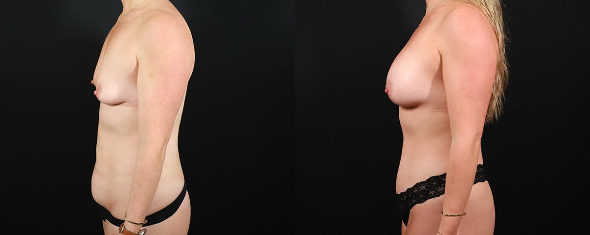 Mommy Makeover Before & After Gallery - Patient 166928 - Image 3