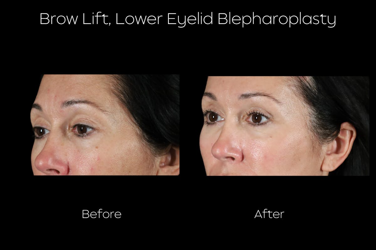 Brow Lift Before & After Gallery - Patient 579752 - Image 3