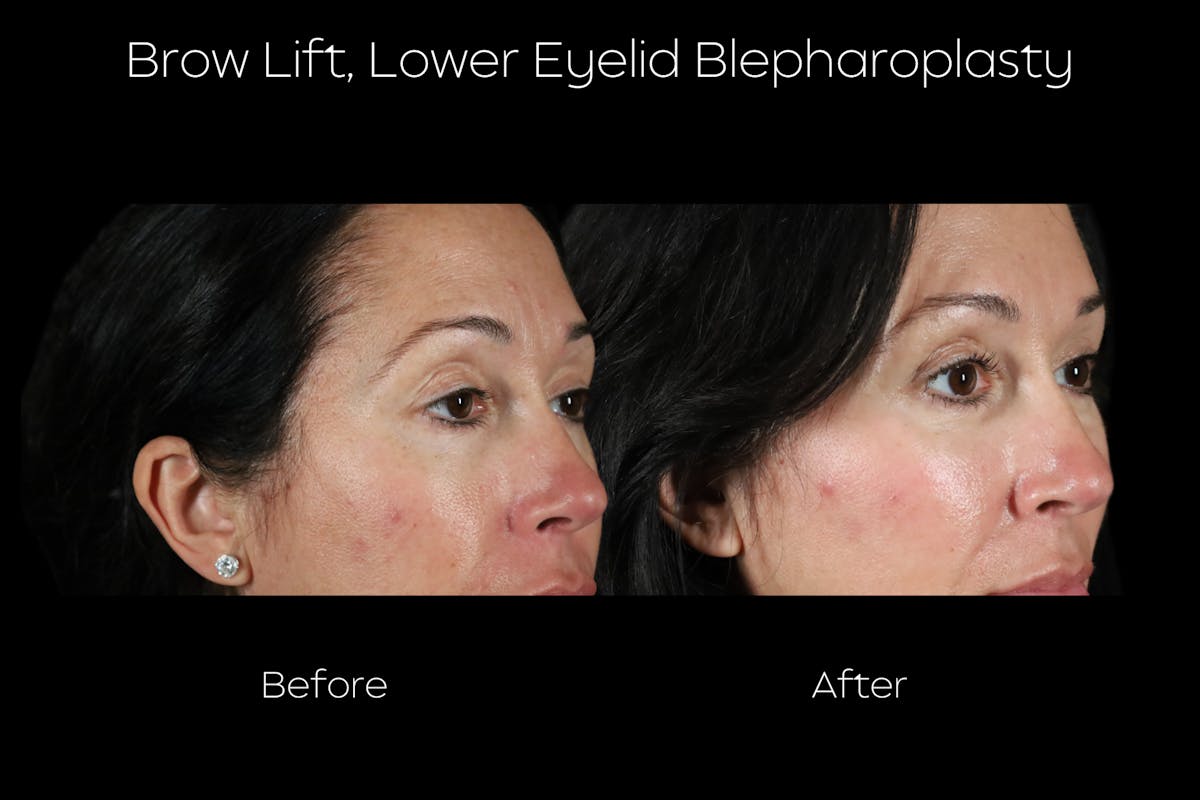 Brow Lift Before & After Gallery - Patient 579752 - Image 2