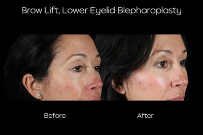 Chemical Peel Before & After Gallery - Patient 524270 - Image 2