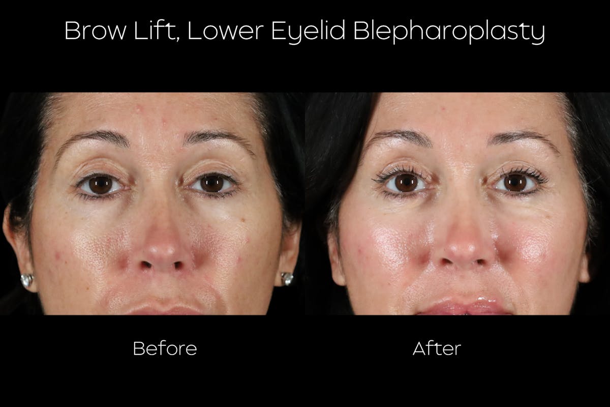 Brow Lift Before & After Gallery - Patient 579752 - Image 1