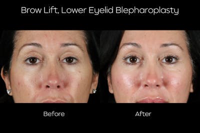 Brow Lift Before & After Gallery - Patient 579752 - Image 1