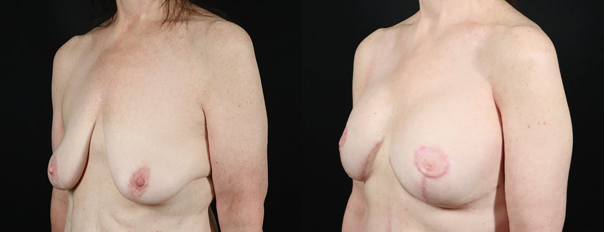 Breast Lift Before & After Gallery - Patient 257748 - Image 2