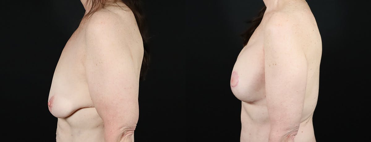 Breast Lift Before & After Gallery - Patient 257748 - Image 3
