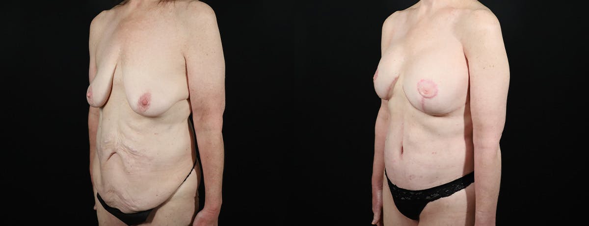 Abdominoplasty (Tummy Tuck) Before & After Gallery - Patient 315695 - Image 2