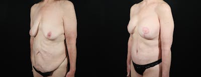 Abdominoplasty (Tummy Tuck) Before & After Gallery - Patient 315695 - Image 2