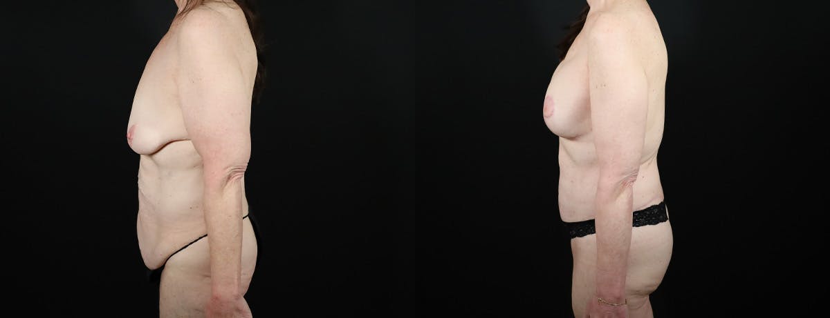 Abdominoplasty (Tummy Tuck) Before & After Gallery - Patient 315695 - Image 3