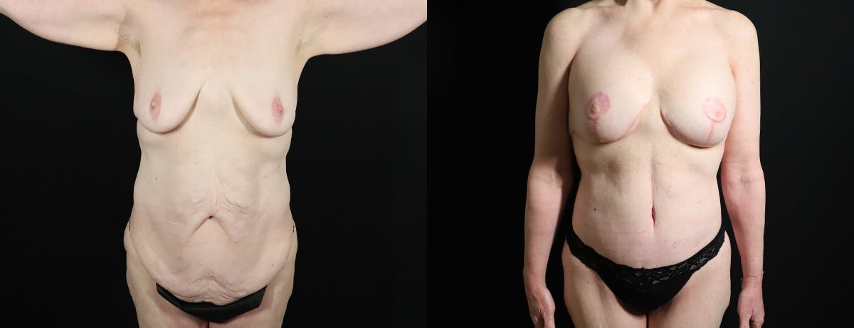 Abdominoplasty (Tummy Tuck) Before & After Gallery - Patient 315695 - Image 1