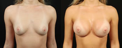Breast Augmentation Before & After Gallery - Patient 102482 - Image 1