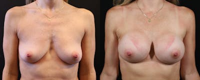 Breast Augmentation Before & After Gallery - Patient 197289 - Image 1