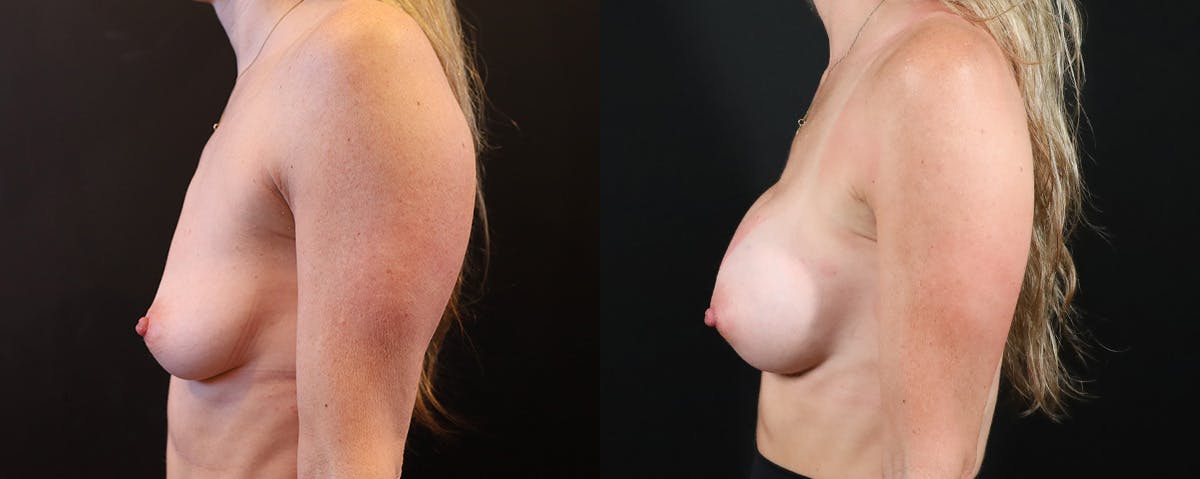 Breast Augmentation Before & After Gallery - Patient 197289 - Image 3