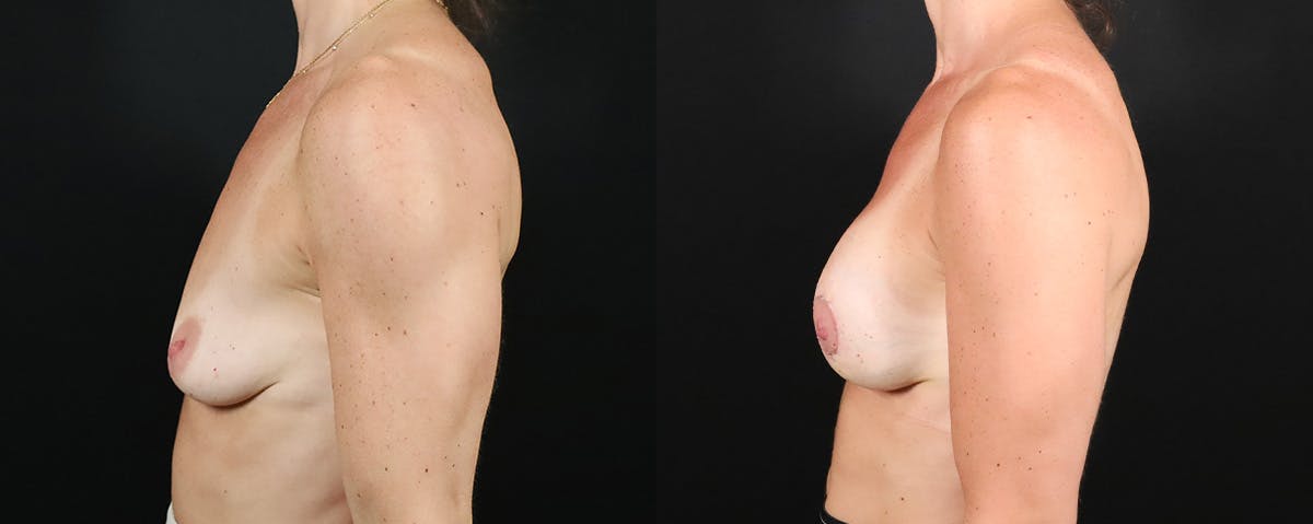 Breast Augmentation Before & After Gallery - Patient 160872 - Image 3
