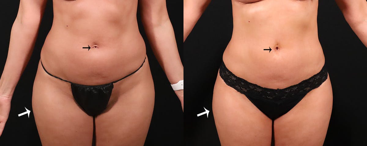 Abdominoplasty (Tummy Tuck) Before & After Gallery - Patient 603625 - Image 1