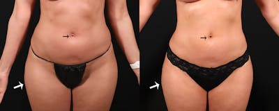 Abdominoplasty (Tummy Tuck) Before & After Gallery - Patient 603625 - Image 1