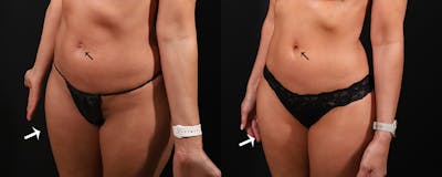 Abdominoplasty (Tummy Tuck) Before & After Gallery - Patient 603625 - Image 2