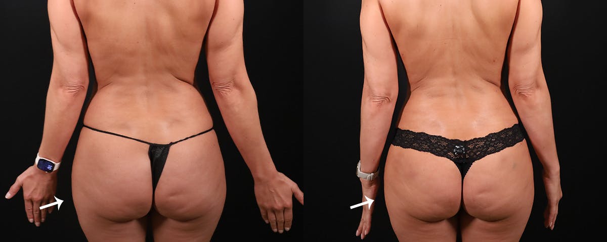 Abdominoplasty (Tummy Tuck) Before & After Gallery - Patient 603625 - Image 3