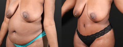 Abdominoplasty (Tummy Tuck) Before & After Gallery - Patient 144227 - Image 2