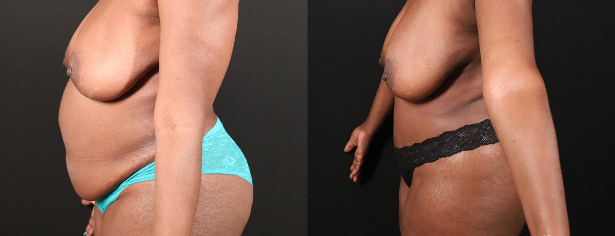 Abdominoplasty (Tummy Tuck) Before & After Gallery - Patient 144227 - Image 3
