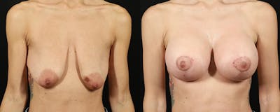 Breast Augmentation Before & After Gallery - Patient 221717 - Image 1