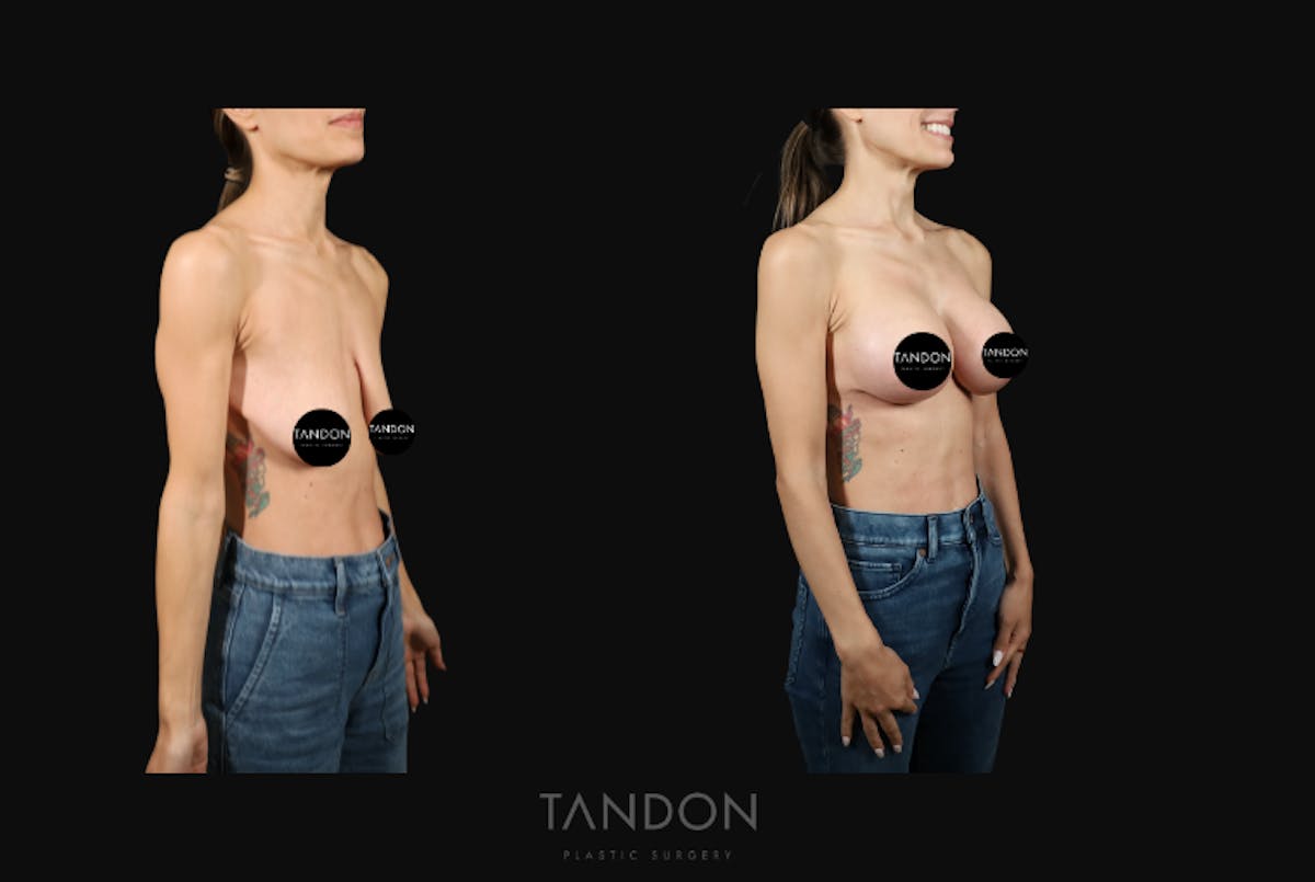 Breast Lift Before & After Gallery - Patient 103225 - Image 2
