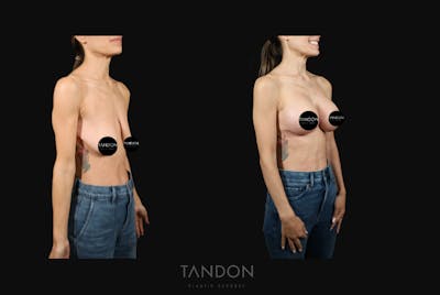 Breast Lift Before & After Gallery - Patient 103225 - Image 2