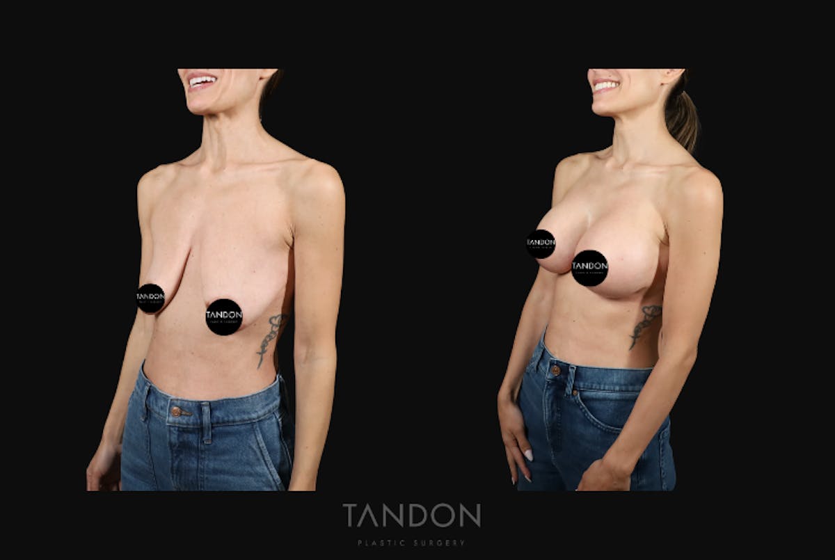 Breast Lift Before & After Gallery - Patient 103225 - Image 3