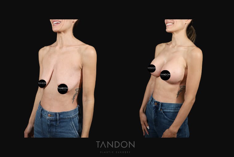 Breast Lift Before & After Gallery - Patient 103225 - Image 3