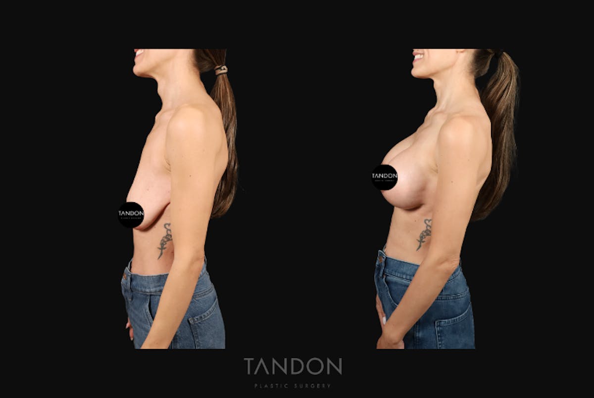 Breast Lift Before & After Gallery - Patient 103225 - Image 5