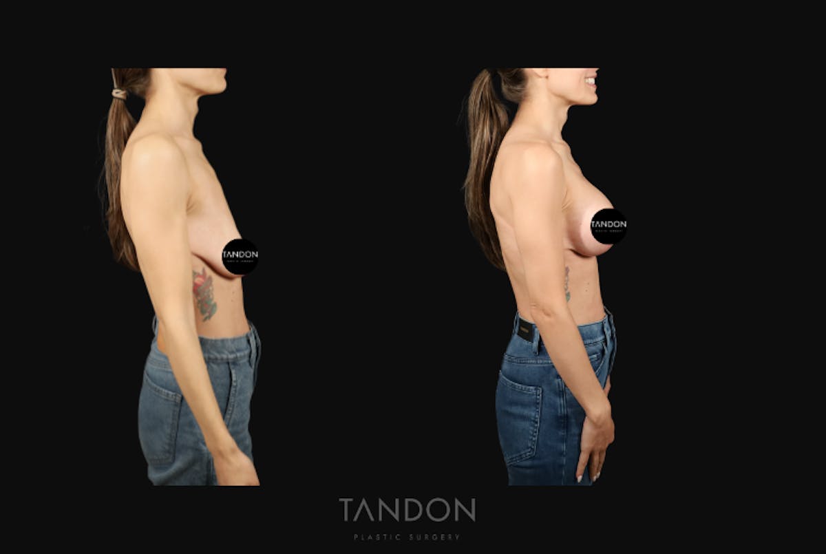 Breast Lift Before & After Gallery - Patient 103225 - Image 4