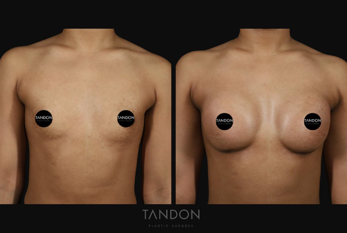 Preservé by Motiva Breast Augmentation Before & After Gallery - Patient 310632 - Image 1