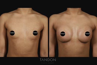 Breast Augmentation Before & After Gallery - Patient 341729 - Image 1