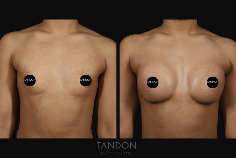 Preservé by Motiva Breast Augmentation Before & After Gallery - Patient 310632 - Image 1
