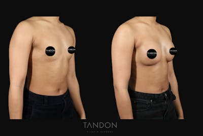 Preservé by Motiva Breast Augmentation Before & After Gallery - Patient 310632 - Image 2