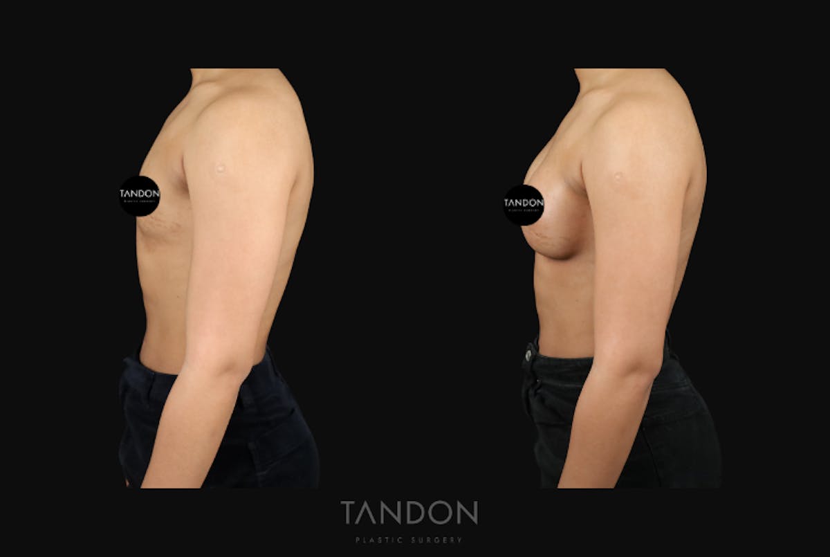 Preservé by Motiva Breast Augmentation Before & After Gallery - Patient 310632 - Image 3