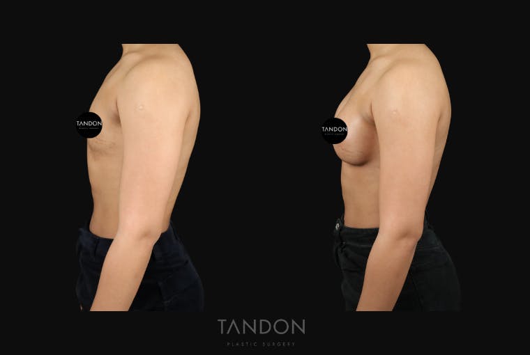 Preservé by Motiva Breast Augmentation Before & After Gallery - Patient 310632 - Image 3
