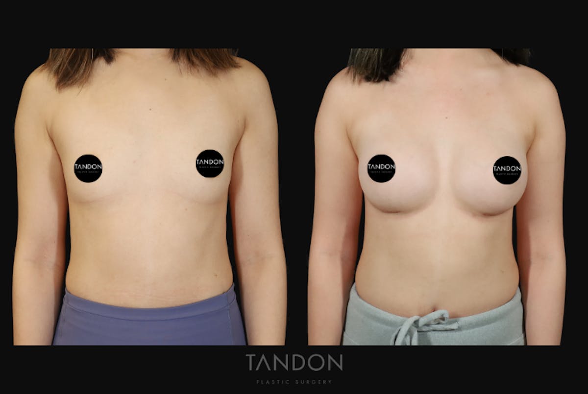 Breast Augmentation Before & After Gallery - Patient 167079 - Image 1
