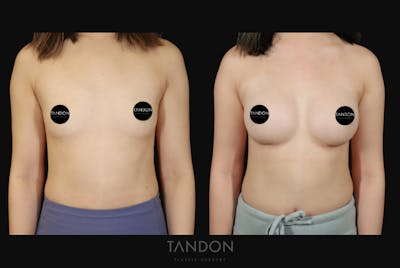 Breast Augmentation Before & After Gallery - Patient 152731 - Image 1