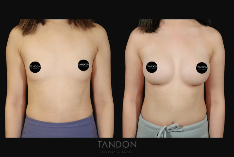 Breast Augmentation Before & After Gallery - Patient 167079 - Image 1